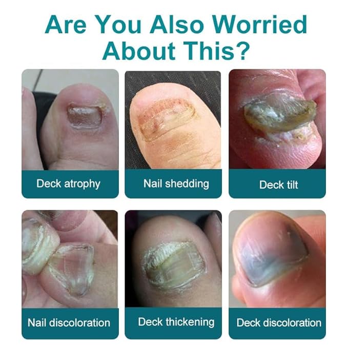 Toenail Fungus Treatment Extra Strength, Upgraded Toe Nail Fungus Treatments, Fungus Nail Treatment, Toe Fungus Treatment for Toenail, Safely and Gently 1 Fl Oz