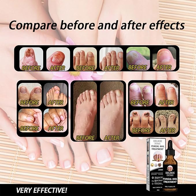Fungal Nail Treatment Repairs Nail Discoloration and Thickness, nail fungus treatment extra strength 30ml 2PCS