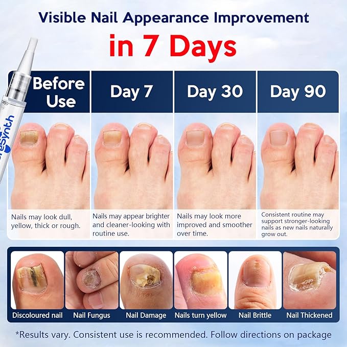Extra Strength Nail Fungus Repair Pen (OTC Maximum Strength), 25% Undecylenic Acid + Aloe & Vitamin E, For Thick Yellow Discolored Nails, 24 mL (0.81 fl oz) Total, 8-Pack,Designed in USA (White)