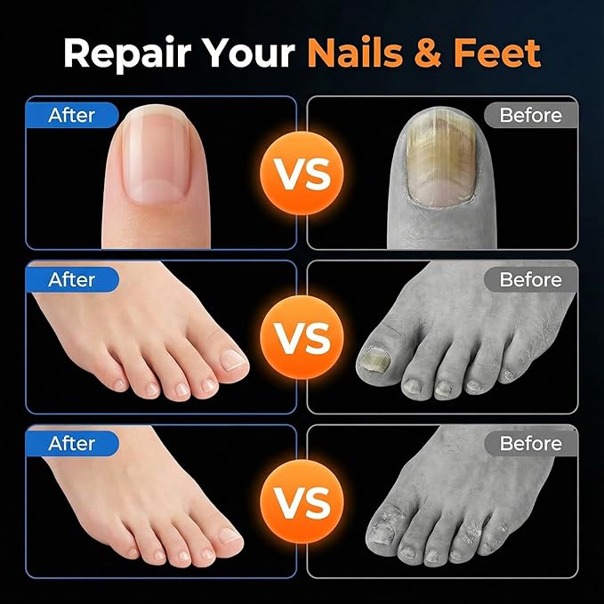 Athletes Foot Spray Treatment, Toenail Fungus Treatment Extra Strength Pen for Toenail & Finger, More Pure Natural Plant Extracts, Foot Fungus Treatments