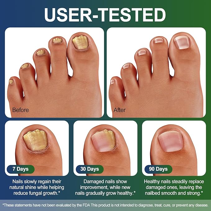 Toenail Fungus Treatment Extra Strength With 25% Undecylenic Acid - Nail Fungus Treatment Extra Strength Pen For Thick, Yellow, Brittle, Discolored Toenails & Fingernails Toenail And Fingernail Repair
