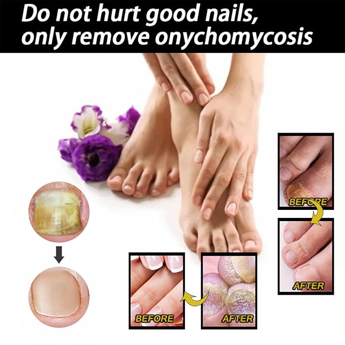 Fungal Nail Treatment Repairs Nail Discoloration and Thickness, nail fungus treatment extra strength 30ml 2PCS