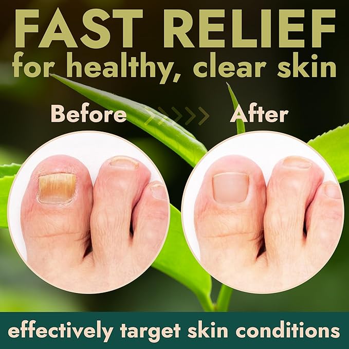 Nail Fungus Treatment for Toenail & Fingernails | Antifungal Nail Treatment with Tea Tree Oil | Fast-Acting, No-Touch Applicator | Restores Thickness & Discoloration | Results in 2 Days | 20g